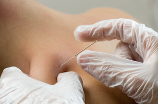 What Is Dry Needling? Does It Really Work?