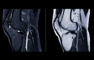 Do Ligaments Really Heal?