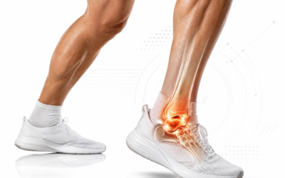 Ankle Osteoarthritis in Athletes